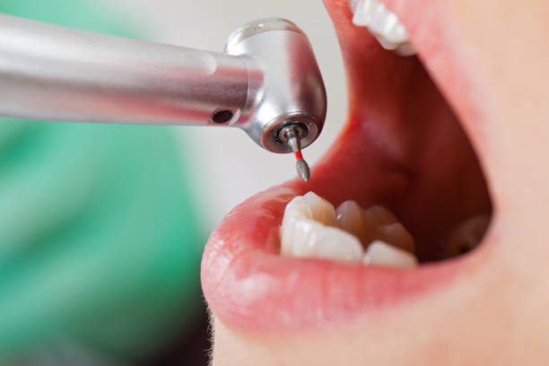 Best Emergency Dentist for Knocked-Out Tooth in Perry Park, CO